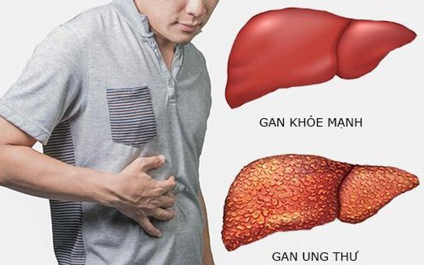 Chăm Sóc Điều Trị Bênh Nhân Ung Thư Gan Tại Nhà Bình Dương